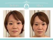 美人バスト 表参道店/【フェイシャル☆症例/表参道】