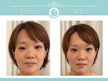 美人バスト 表参道店/【フェイシャル☆症例/表参道】