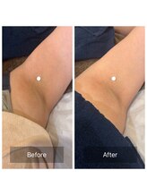 フェムーン(FEMOON)/透明肌！クリアピール脱毛（脇）