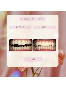 プラスビー 2号店(+b)/ホワイトニングビフォーアフター