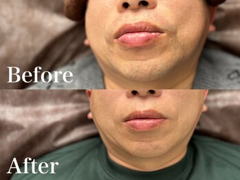 ボス 岡崎店(BOSS)/【顔脱毛/ヒゲ脱毛】あご　#脱毛