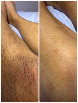 アンヴィオ ギンザ(Anvio Ginza)/膝下ワックス脱毛