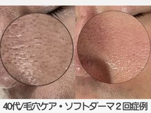 ラ コケット(La Coquette)/内側から弾力肌|凸凹肌/開き毛穴