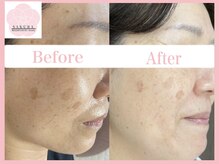 サクラ(SAKURA)/シミケアのみでもお肌はキレイ