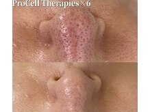 ルチル(Rutile)/プロセルセラピーズフェイシャル