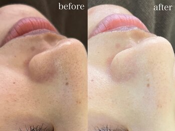 テオリア(TEORIA)/ビタミンC導入で美白ケア♪