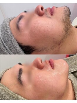 ミリプラス(MiLi +)/ヒゲ/産毛