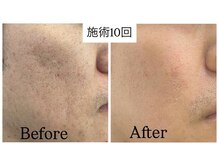 ファソ ブロウアンドアイズ(fasol)の雰囲気（韓国式☆ハーブピーリング/ニキビ・シミ・凸凹肌を内側からケア）
