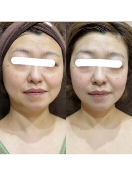 トゥーリ 春日店(tuuli)/ビフォーアフター