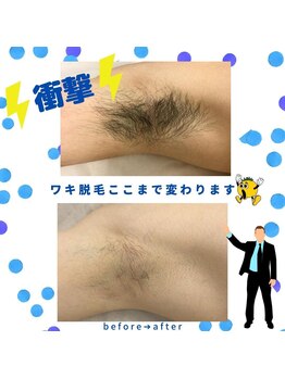 アトレ(Atre)/メンズ脇脱毛☆