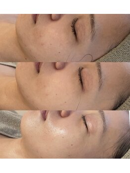 ホワイトアクア 中目黒店(WHITE AQUA)/ララピール1ヶ月