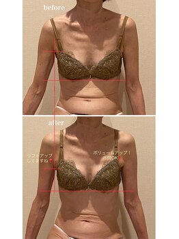 プリマベラ 花隈店(Primabella)/バストアップ☆ビフォーアフター