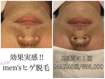 エステティックサロン アールグレー 名古屋駅店/効果実感◎【メンズ脱毛】ヒゲ