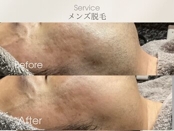 フェイシャルサロン ベルダ(BELDA)/【メンズ髭脱毛】