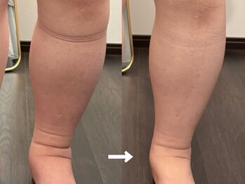 ヴィセラ(Vicella)/むくみが!