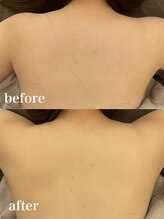 ディオーネ 自由が丘(Dione)/背中脱毛【20代 施術1回 】