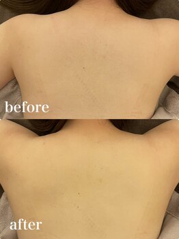 ディオーネ 自由が丘(Dione)/背中脱毛【20代 施術1回 】