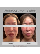 リュクシー(LuxeY)/50代小顔造形フルコース3回施術