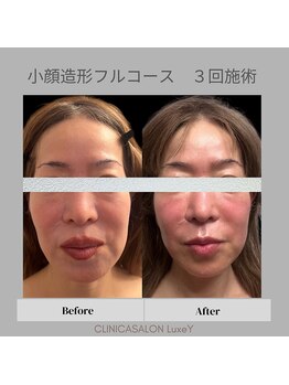 リュクシー(LuxeY)/50代小顔造形フルコース3回施術
