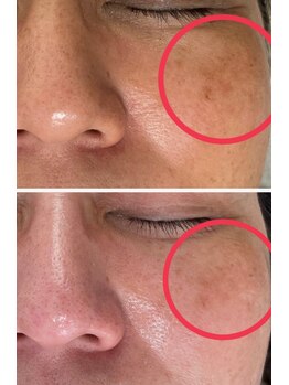 エン(enn)/光フェイシャル【頬のシミ改善】