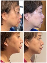 インファイン ハミルトン店(infine)/道内初！二重顎ほうれい線・小顔