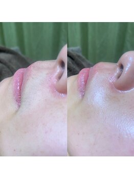 ナチュウル(Natulu)/日本式シルク糸脱毛