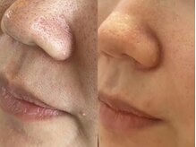 スムース イー(Smooth+E)/イチゴ鼻も改善！人気の毛穴洗浄