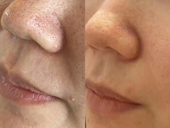 スムース イー(Smooth+E)/イチゴ鼻も改善！人気の毛穴洗浄