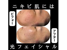 エステティックサロン ナゴミ(和)の雰囲気（光フェイシャル）