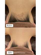 オアシス カナヤマ(Oasis kanayama)/【うなじ脱毛】