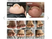 ロルズ(lol's.)の雰囲気（ジェルネイルをしながら巻き爪を緩和）