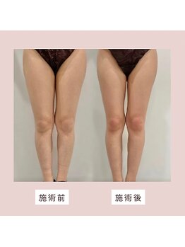 ミーティス/脚のインディバ90分♪症例写真