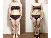 カトレア 下関店(KATOREA)/カトレアの痩身★BeforeAfter