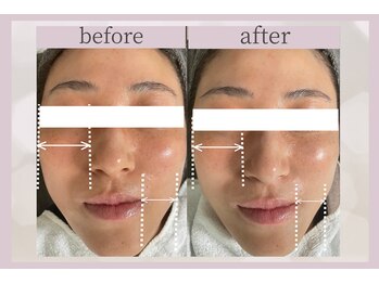 ミロワール(Miroire)/フェイスラインのすっきり感