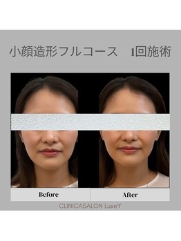 リュクシー(LuxeY)/小顔造形フルコース 1回施術