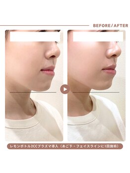 イエス マイサロン(yes My Salon)の写真/韓国発◆話題の脂肪分解美容液《レモンボトル》はダウンタイムなしで瞬間小顔が叶う◎プラズマ導入で効果UP