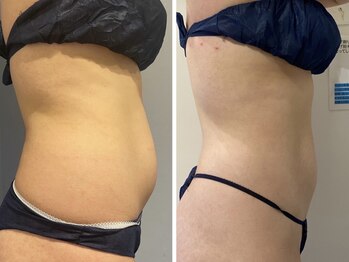 エイシスグロウ(asis glow.)/効果写真