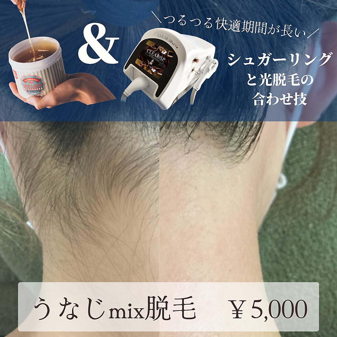 【うなじmix脱毛】シュガーリング脱毛＋光脱毛の合わせ技つるつる期間が長い