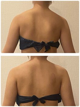 うつくし痩身 美サロン ゼットワン(Z-ONE)/メディセル１回　before　after