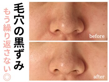 エリン(ERIN)/毛穴徹底洗浄　２回目