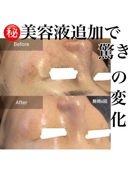 サロンツキ(salon tuki)/光フォト症例【徳島/シミケア】