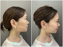 アルムボーテ 代官山 恵比寿(ARUIM Beaute)/シェービングビフォーアフター