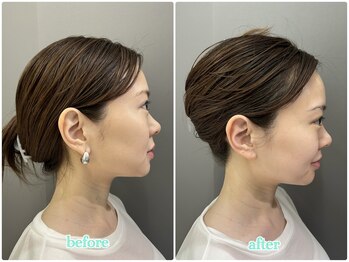 アルムボーテ 代官山 恵比寿(ARUIM Beaute)/シェービングビフォーアフター