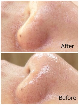 ハクミー(haku me)/☆鼻毛穴の汚れ黒ずみの変化☆