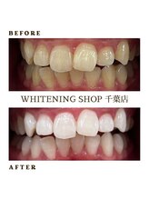 ホワイトニングショップ 千葉店/歯科提携　ホワイトニング専門店