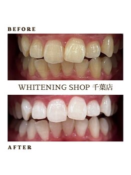 ホワイトニングショップ 千葉店/歯科提携　ホワイトニング専門店