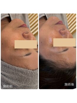 【医療提携】毛穴・たるみ・美肌育成専門店　緒々one＋【チョチョワンプラス】/韓国水光肌ピーリング