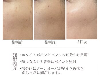 リノア 柏(Lino'a)/ポイントシミケア角化を促します