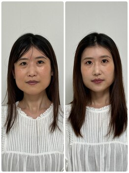 ブルースター(BLUE STAR)/メイクで小顔矯正並みの変化☆