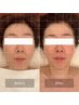 歪み・食いしばり改善【チノザメソッド小顔調整】face  ¥22000→¥11000